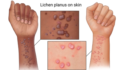 Lichen Planus Therapeutic Methods